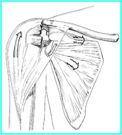 Cuff Tear Arthropathy