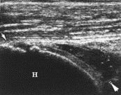 Rotator Cuff Tears