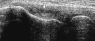 Tennis Elbow