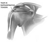 Rotator Cuff Tears