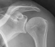 Shoulder Arthritis