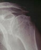 Shoulder Arthritis