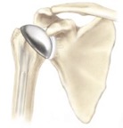 Shoulder Arthritis