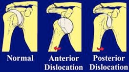 Shoulder Instability