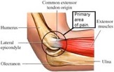 Tennis Elbow