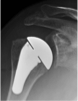 Reverse Shoulder Replacement