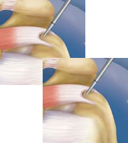 Rotator Cuff Tears