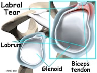 SLAP Tear