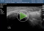 Tennis Elbow